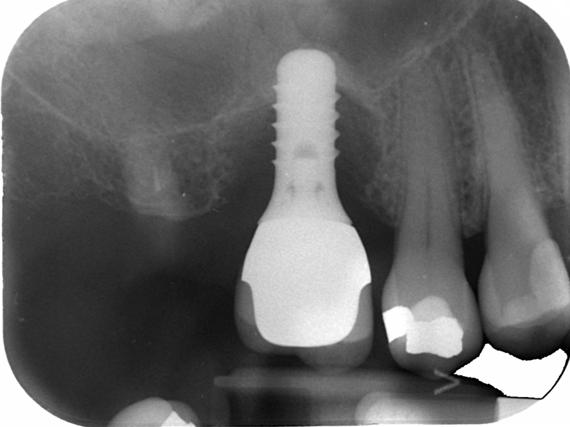 Periimplantitis radiograph after treatment